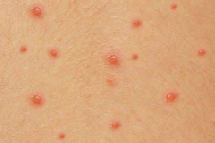 chickenpox vaccination Cardiff