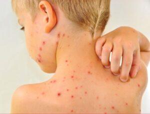 chickenpox vaccination cyncoed cardiff